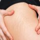 Comment atténuer ses vergetures avant l’été ?