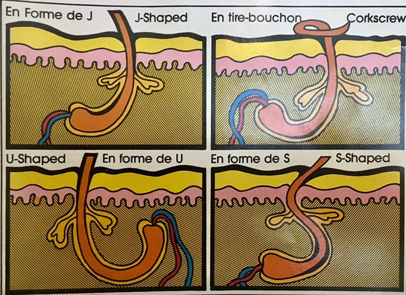 Exemple de follicules pileux - Dr Cheriet, médecin esthétique à Paris